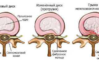 Можно ли рожать с межпозвоночной грыжей?