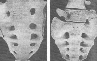 Люмбализация первого крестцового позвонка — что это такое?