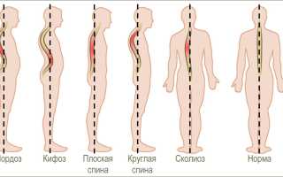 Осанка — норма и патология