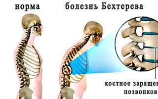 Спондилоартрит позвоночника: симптомы и лечение