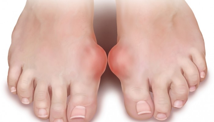 1358173739_podagra-prichiny-simptomy-priznaki-i-lechenie