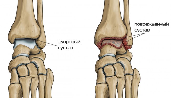 1427396159_kak-vyglyadit-artroz-v-golenostope