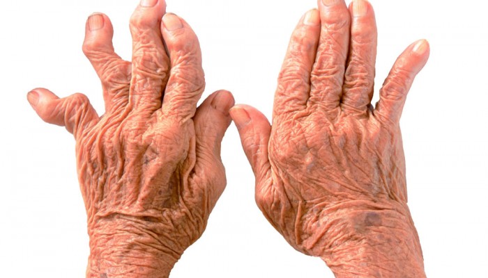 1428430992_posledstviya-artrita-palcev