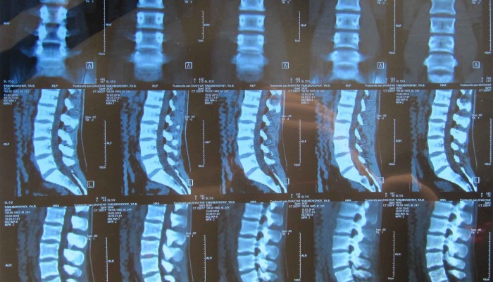 23378755-kt-osteohondroza