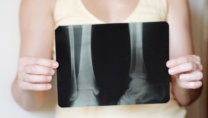 Woman holding an x-ray image on foot