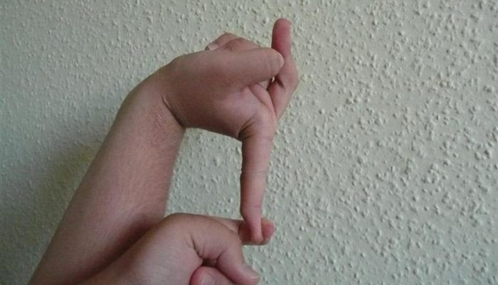 ehlers-danlos_syndrome2