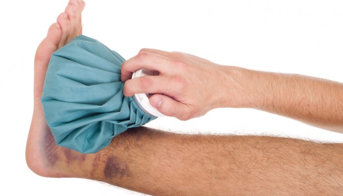 Icing a sprained ankle