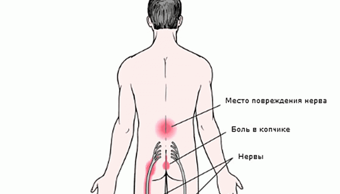 radikulopatiya-poyasnichno-kresttsovogo-otdela-pozvonochnika