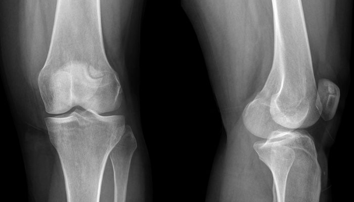 rentgen-patella-bipartita-1