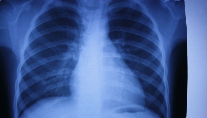 Травматология-survey_radiography_of_the_chest