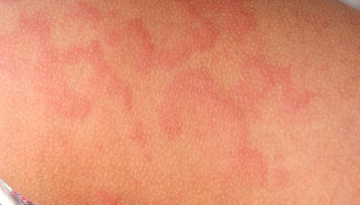 allergicheskaja-reakcija