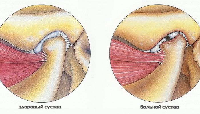 artrit-nizhnecheliustnogo-sustava
