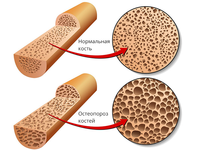 densitometriya