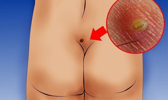 epitelialnyy_kopchikovyy_hod_1