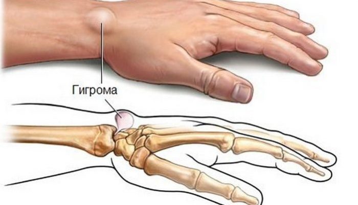 gigroma-luchezapyastnogo-sustava-kisti