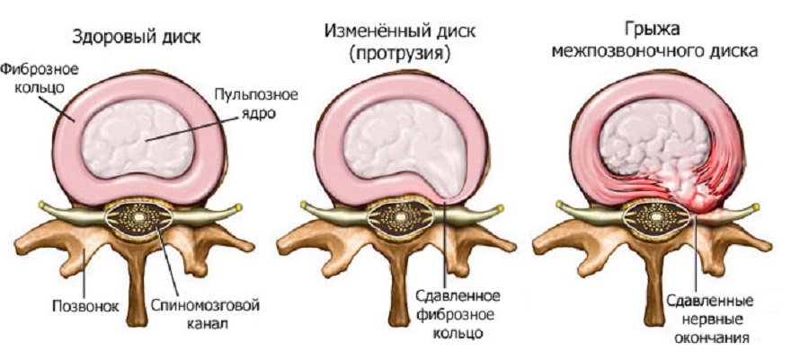 gryza