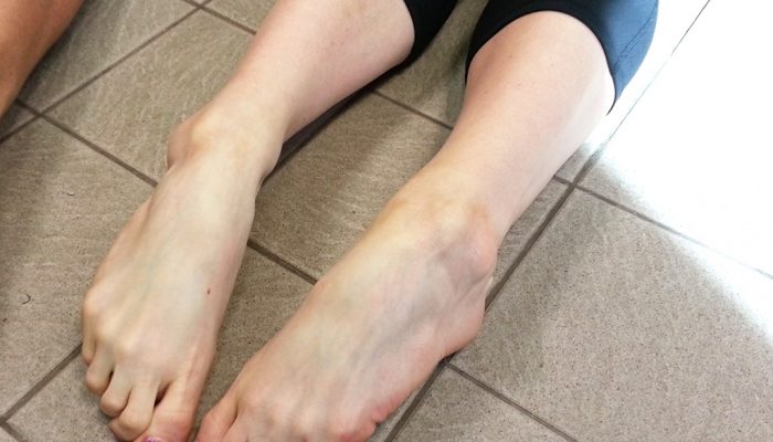 hypermobile-feet-eds