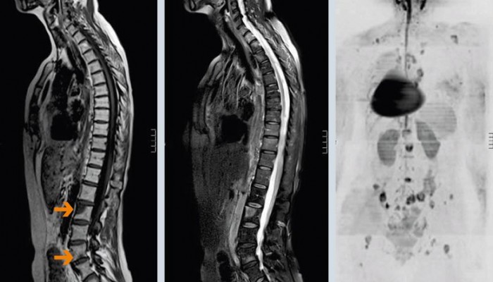 metastazy_v_pozvonochnike_3