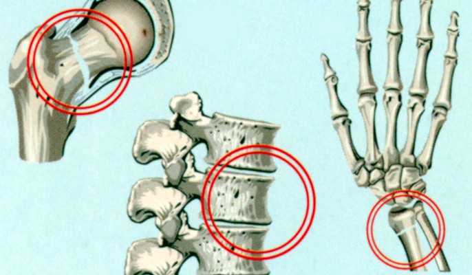 osteoporoz3