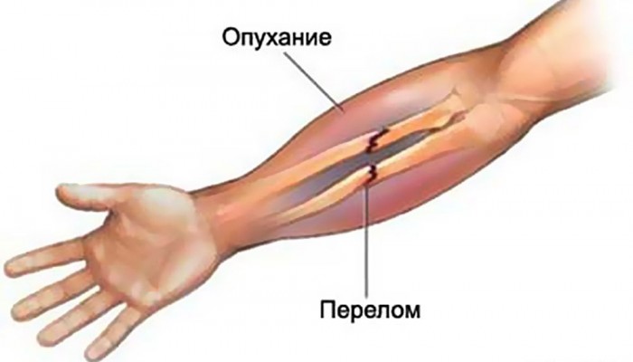 perelomy-kostej-predplechya2