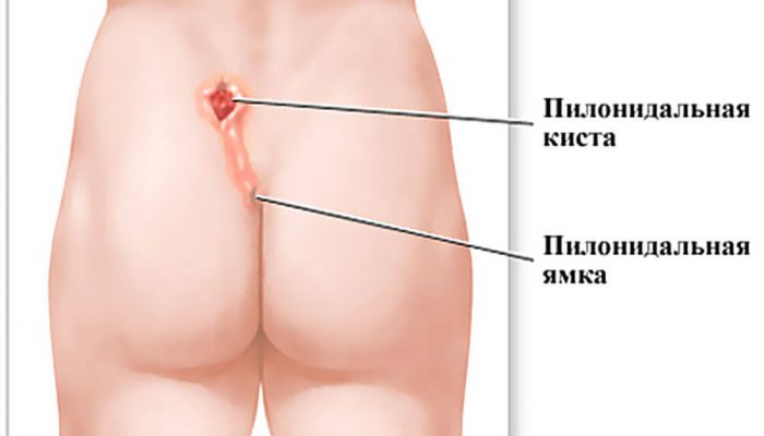 pilonidalnaja-kista2