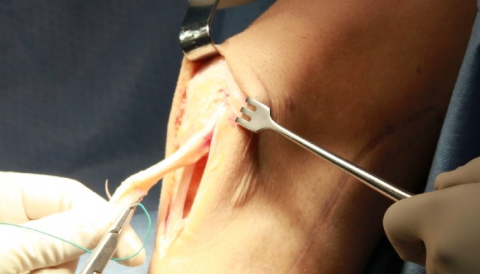 proshivanie_transplantanta