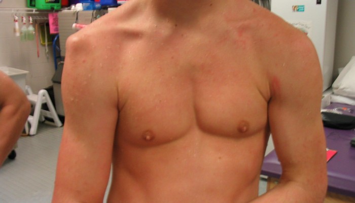 shoulder-dislocation-142D44EC0451F562123