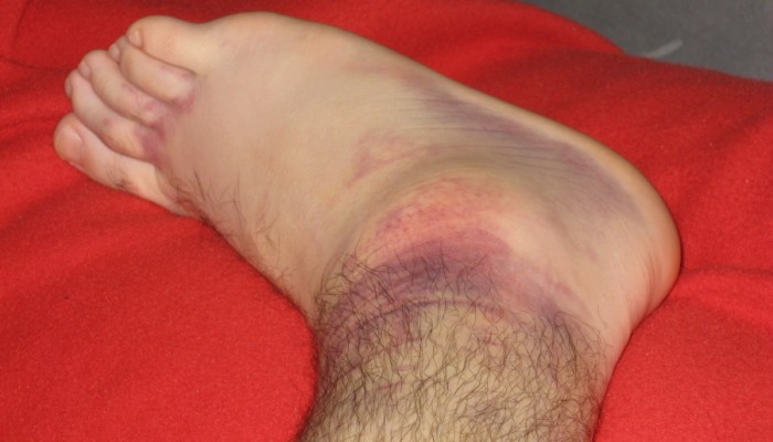 tendovaginit-golenostopnogo-sustava