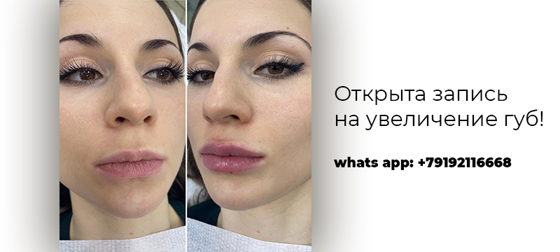Увеличение губ в Курске